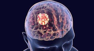 Beynindeki Tümörden Sohbet Ederken Kurtuldu! 