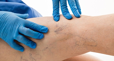 FAZLA KİLO VE VARİSLER AKCİĞER EMBOLİSİ RİSKİNİ ARTIRIYOR