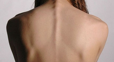 HER 10 GENÇ KIZDAN BİRİNİN SORUNU: SKOLYOZ 