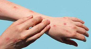 Maymun çiçeği salgını,Uluslararası Halk Sağlığı Acil Durumu ilan edildi