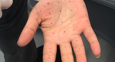 Terlemenin çözümü botoks