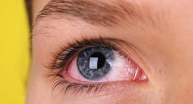 Güneş Işığında Kuş Kanadı Hastalığı Riski