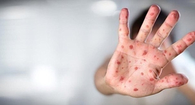 Maymun çiçeği salgını düşüşe geçti 