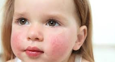 OKULLARDA BESİN ALERJİSİ FARKINDALIĞI SAĞLANMALI