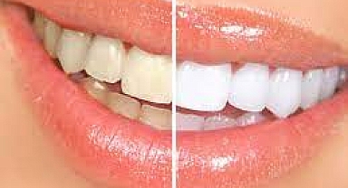 Bembeyaz dişlerim olsun diyorsanız, dikkat!