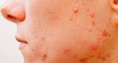 Sivilcelerden kurtulmanın yolları