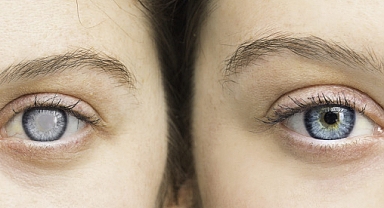 Kornea Naklinde Yeni Teknikler Avantaj Sağlıyor