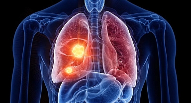 Sigara akciğer kanseri riskini 20 kat arttırıyor