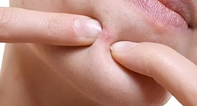 SİVİLCELERDEN KURTULMA YOLLARI NELERDİR? Asla bunu yapmayın!