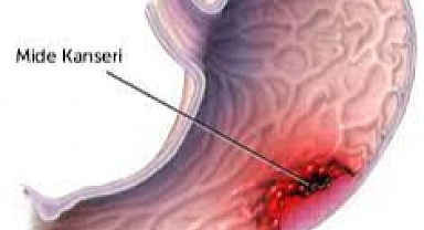 Mide kanseri belirtileri ülser ile karıştırılabilir 