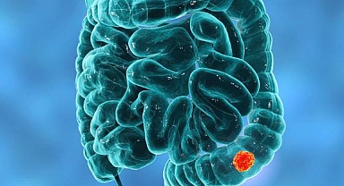 Aşırı kırmızı et tüketimi kolon kanserini tetikleyebilir