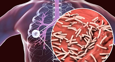 Covid'den sonra en çok öldüren bulaşıcı hastalık verem oldu