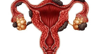 ENDOMETRİOZİSİN 3 ÖNEMLİ SİNYALİ