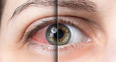 Glokom İçin Tek Çare Erken Teşhis