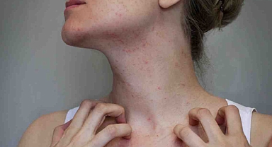 Şu sıralar uyuz hastalığına dikkat!