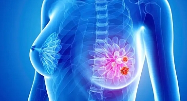 Yapay zekâ meme kanserini tespit ediyor!