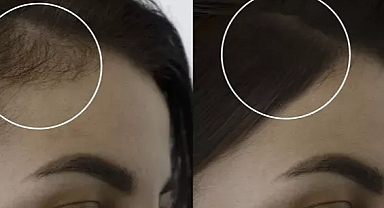 1 haftada dökülmeyi durduruyor! Dökülen saçlarınızı geri kazanmanızı sağlayan maske tarifi