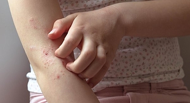 Bahar alerjisi ve deri hastalıklarına dikkat! 