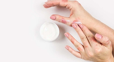 Egzama hakkında bilinmeyenler