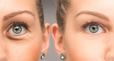 Göz altı morluk ve şişliklerini anında geçiren yöntem! Sosyal medyada herkes o yöntemi deniyor...