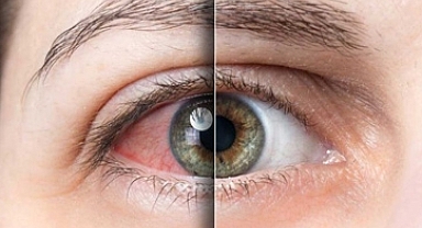 GÖZLERDE GEÇMEYEN KIZARIKLIĞIN ALTINDA ÜVEİT YATIYOR OLABİLİR! 