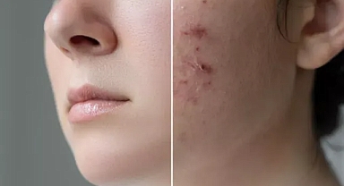 İbn-i Sina binlerce yıl önce reçetesini verdi: İşte sivilceyi kurutan tek besin!