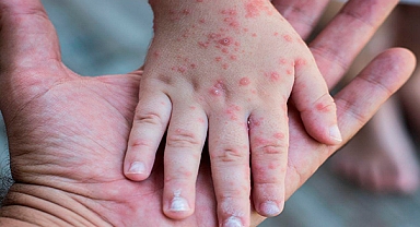 Prof. Dr. Yavuz'dan kızamık salgını uyarısı 