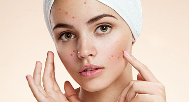 Yüzdeki sivilce ve siyah noktaları coşturuyor! Sakın yemeyin, cildi mahvediyor