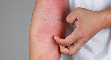 Baharda alerjiye bağlı cilt hastalıklarında artış görülüyor 