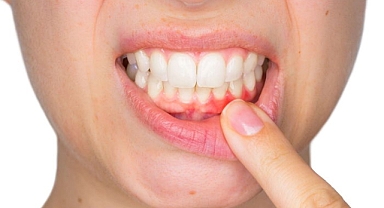 Çekilen diş eti eski haline gelmez