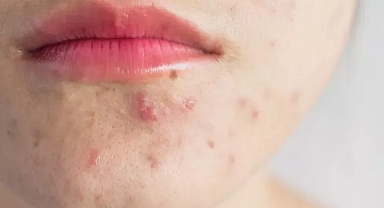 Cildi mayın tarlasına çeviriyor! Göründüğü gibi masum değil, herkes yararlı olduğunu söylüyordu