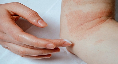 Egzamayı önlemenin 10 yolu