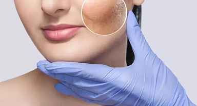 Gözeneksiz bir ciltle 10 yaş genç görünmek mümkün! Gözenekleri küçülten muhteşem yöntem