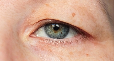 Her göz kapağı düşüklüğü ameliyat gerektirmez