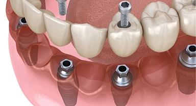 İmplant üstü protezlerle her yaşta diş konforunu yaşama imkânı var
