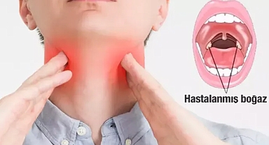 RTEÜ'den boğaz enfeksiyonunda kullanılan antibiyotiklere alternatif çözüm