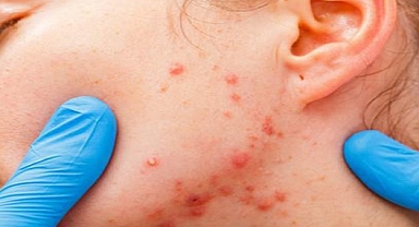 Uzmanlardan sivilce ve aknelere karşı arı zehri ve propolis önerisi 