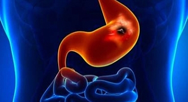 Yaşlı hastalarda ülserler sık görülüyor Ağrı kesiciler ve kan sulandırıcılar ülsere neden olabilir 