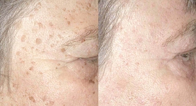 Yaşlılık izlerinden kurtulmak işte bu kadar basit! Botoks etkisi kanıtlanmış maske tarifi!