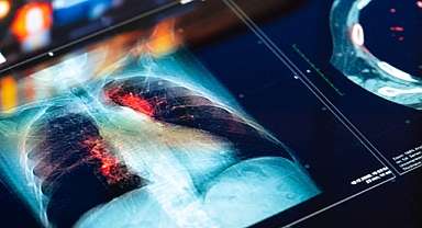 Yeni yapay zekâ aracı kanseri teşhis edebiliyor