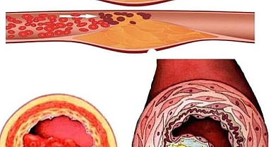 Yüksek tansiyonu düşürmek için lütfen ilaç kullanmayın. Bundan bu çare almak daha iyidir...