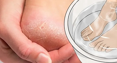 Bu yöntem çatlamış topukları yumuşacık yapıyor...