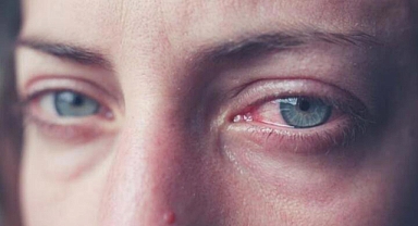 Güneş alerjiyi ciddi şekilde artırıyor