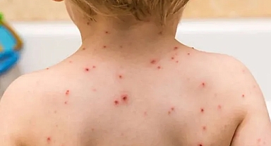 İstanbul’da kızamık alarmı! 