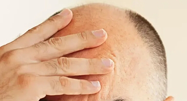 Kalıcı saç dökülmesinin şaşırtan nedeni!