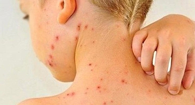 Kızamık Vakalarında Korkutan Artış 