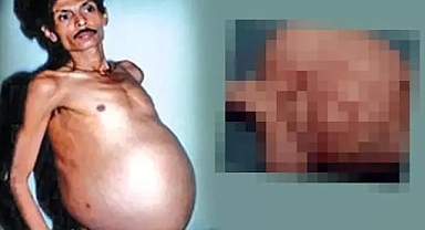 Tüm dünyayı şoke eden 'hamile adam' vakası