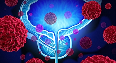 PROSTAT KANSERİNDE HAYAT KURTARAN 4 ÖNERİ