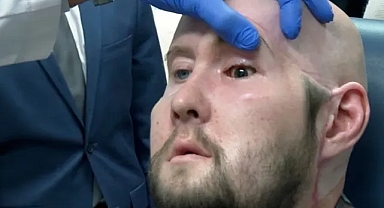 Körlük tarih mi olacak? Tıp dünyasında bir ilk. Sağlıkta devrim gibi ameliyat. New York'ta dünyanın ilk göz nakli ameliyatı yapıldı