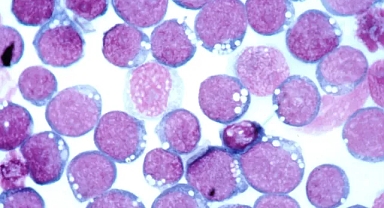 Kelebek hastalığının arkasından da Epstein-Barr virüsü çıktı